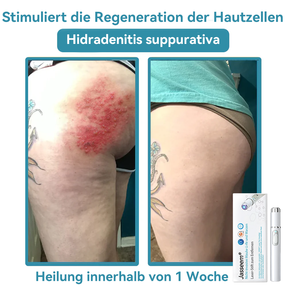 𝐉𝐚𝐬𝐬𝐞𝐞𝐦® 🌳Nicht-invasive Laserstift zur Entfernung von Hautflecken und Warzen (Schnelle und schmerzlose Entfernung von Warzen, Muttermalen, Altersflecken und Hautunreinheiten – ganz ohne Nebenwirkungen) 🔥