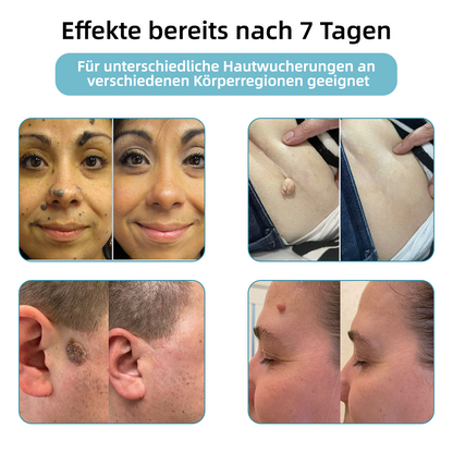 𝐉𝐚𝐬𝐬𝐞𝐞𝐦® 🌳Nicht-invasive Laserstift zur Entfernung von Hautflecken und Warzen (Schnelle und schmerzlose Entfernung von Warzen, Muttermalen, Altersflecken und Hautunreinheiten – ganz ohne Nebenwirkungen) 🔥