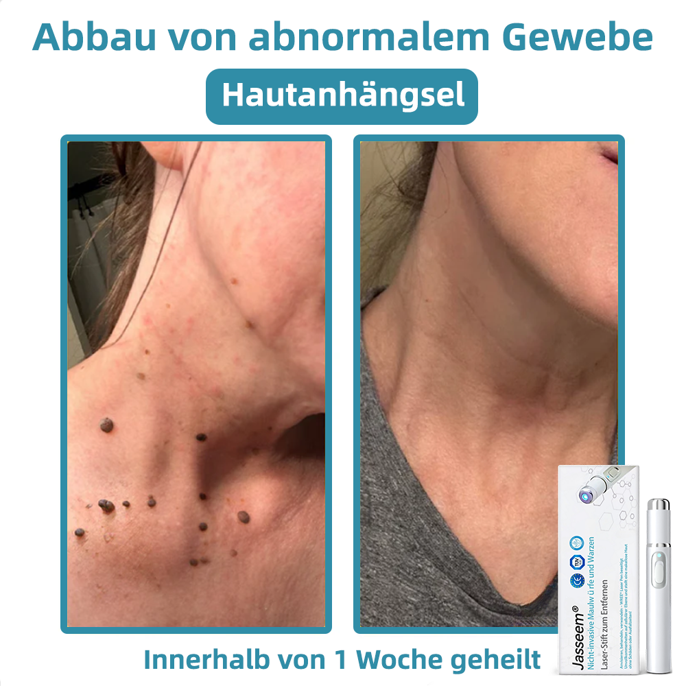 𝐉𝐚𝐬𝐬𝐞𝐞𝐦® 🌳Nicht-invasive Laserstift zur Entfernung von Hautflecken und Warzen (Schnelle und schmerzlose Entfernung von Warzen, Muttermalen, Altersflecken und Hautunreinheiten – ganz ohne Nebenwirkungen) 🔥