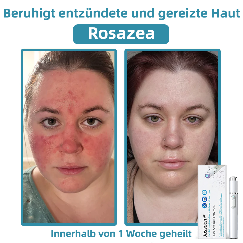 𝐉𝐚𝐬𝐬𝐞𝐞𝐦® 🌳Nicht-invasive Laserstift zur Entfernung von Hautflecken und Warzen (Schnelle und schmerzlose Entfernung von Warzen, Muttermalen, Altersflecken und Hautunreinheiten – ganz ohne Nebenwirkungen) 🔥