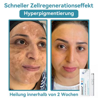 𝐉𝐚𝐬𝐬𝐞𝐞𝐦® 🌳Nicht-invasive Laserstift zur Entfernung von Hautflecken und Warzen (Schnelle und schmerzlose Entfernung von Warzen, Muttermalen, Altersflecken und Hautunreinheiten – ganz ohne Nebenwirkungen) 🔥