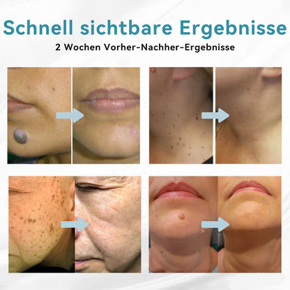 𝐉𝐚𝐬𝐬𝐞𝐞𝐦® 🌳Nicht-invasive Laserstift zur Entfernung von Hautflecken und Warzen (Schnelle und schmerzlose Entfernung von Warzen, Muttermalen, Altersflecken und Hautunreinheiten – ganz ohne Nebenwirkungen) 🔥